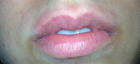 Allergic Reaction On Lip Pictures Photos