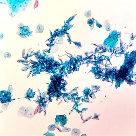 Pathology Outlines Candida Fungi