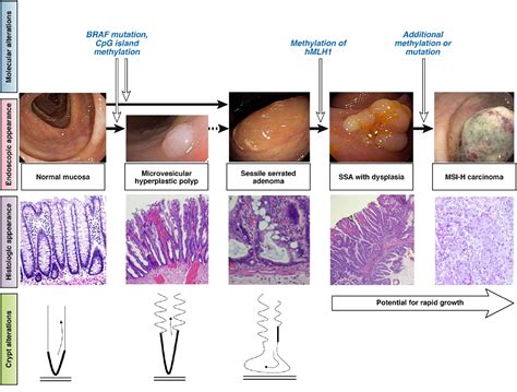 Figure 1 From Sessile Serrated Adenomas An Evidence Based Guide To