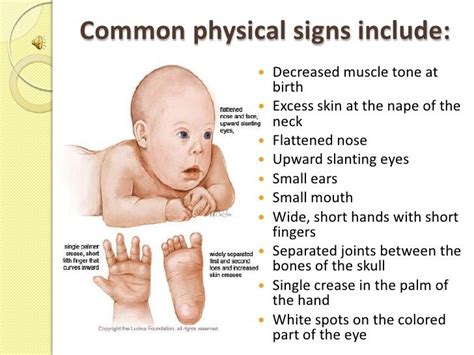 Down Syndrome Causes Symptoms Diagnosis And Treatment