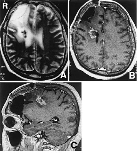 A Axial T Weighted Magnetic Resonance MR Image Obtained Weeks Download Scientific