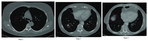 Multiple factors can influence life expectancy. Stages 2, 3 and 4 of lung cancer. | Download Scientific ...