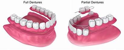 Tooth Replacement Options Dental Implants Dentures Partial
