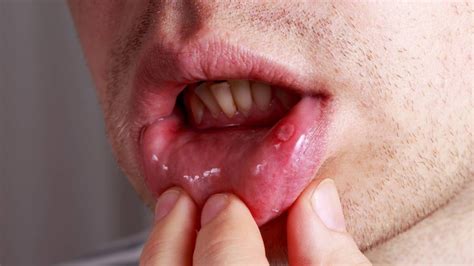 Aphthous Ulcers Causes Symptoms Diagnosis Treatment Medicine Com