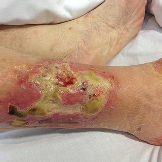 3 it is characterized by because martorell ulcer is a rare syndrome, it is challenging, although important, to characterize. Classificação de Hohl e Moore. Detalhe do tipo I que ...