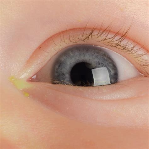 Conjunctivitis In Children Symptoms And Treatments