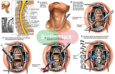 spine surgery c5 6 and c6 7 anterior cervical discectomy with spinal fusion and plating spinal