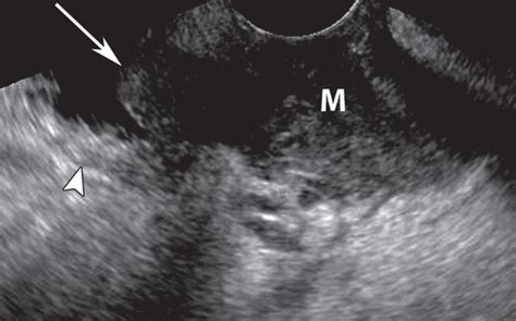 US Of The Nongravid Cervix With Multimodality Imaging Correlation