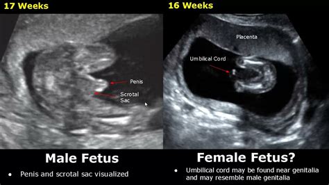Fetal Gender Determination On Ultrasound Determining The Sex Of A