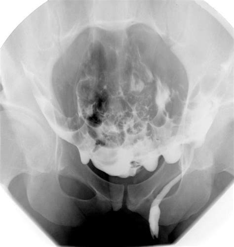 Do you know what hernia symptoms look like? Femoral hernia on herniography | Radiology Case | Radiopaedia.org