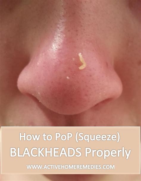How To Pop Blackheads Blackheads Popping Blackheads Squeezing