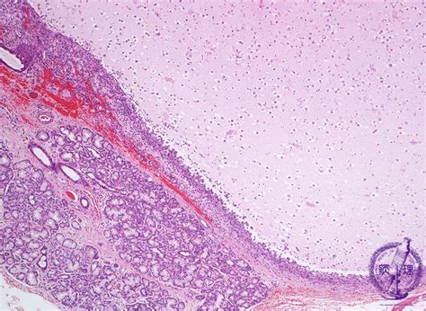 Mucous Retention Cyst Lip Pathology Outlines Sitelip Org