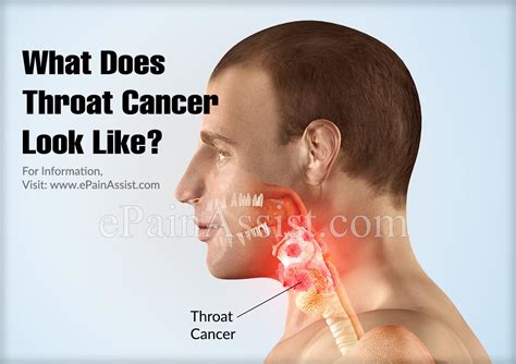 What Does Throat Cancer Look Like Images Q A What You Should Know