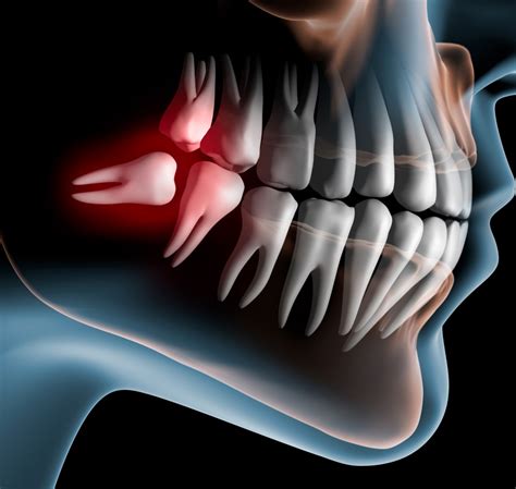 Wisdom Teeth Removal Dentist In Mckinney Tx