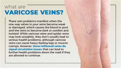 How To Treat Varicose Veins In Your 20s Lounge Doctor