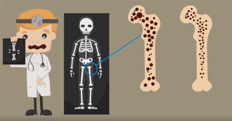 Qué Es La Osteoporosis Qué Es Síntomas Diagnóstico Y Tratamiento