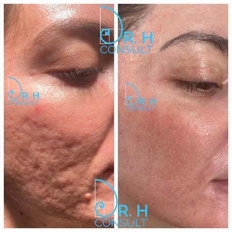 How Much Is Laser Skin Treatment For Acne Scars 5 Acne Scar Laser