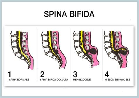 Spina Bifida Medicine And Surgery Nursing Care Pediatric Nursing
