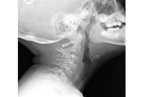 Catastrophic Complications Of Head And Neck Infections Slideshow
