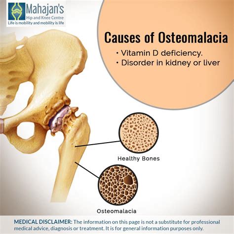 Osteomalacia Due To Vitamin D Deficiency