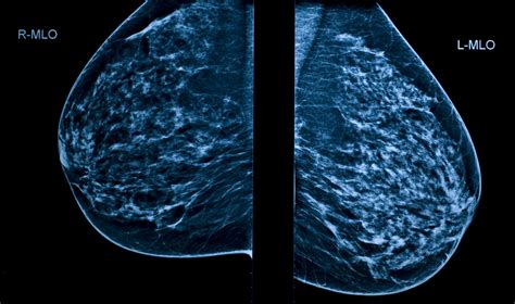 Swollen Lymph Nodes After Covid 19 Vaccines May Cause Mammogram Confusion