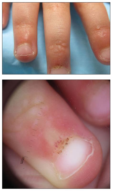 Papules And Telangiectases On The Distal Fingers Of A Child Mdedge