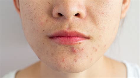 What Causes Baby Acne ~ Squarexdesign