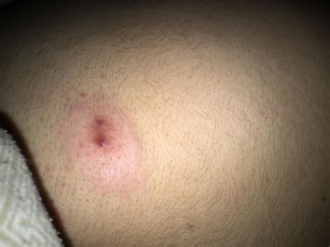 Huge Zit On Upper Butt Cheeck Back Body Neck Acne Acne Org Forum