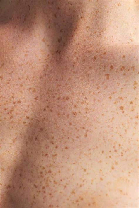 What Are Freckles Plus When To See Your Doctor Artofit
