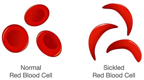 19 June World Sickle Cell Awareness Day And Its Significance