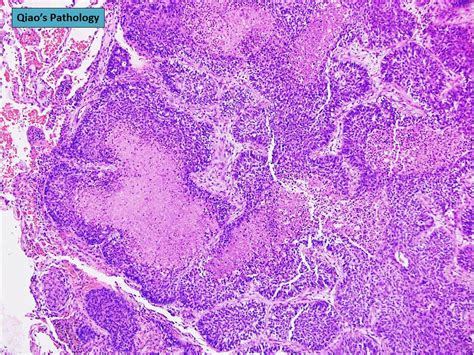 Qiaos Pathology Basaloid Squamous Cell Lung Carcinoma Flickr