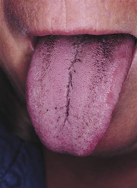 Black Tongue Jama Dermatology Jama Network