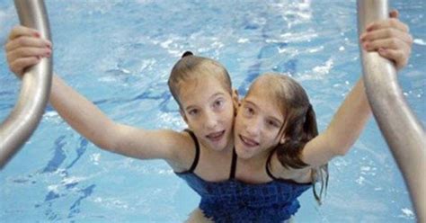 Abby And Brittany Hensel Bikini Longest Living Conjoined Twins The