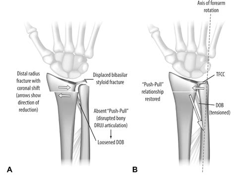 Distal Radioulnar Joint Anatomy