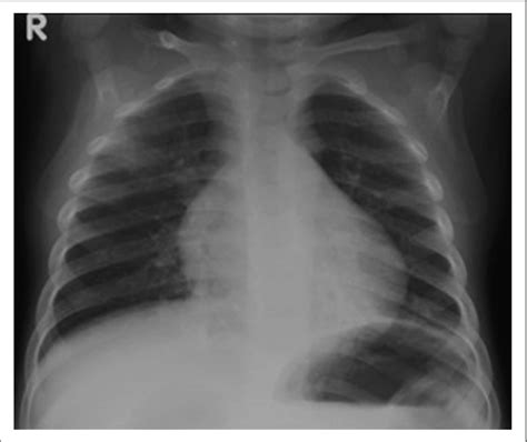 Chest Radiograph On Admission With Features Of Bilateral Pneumonia