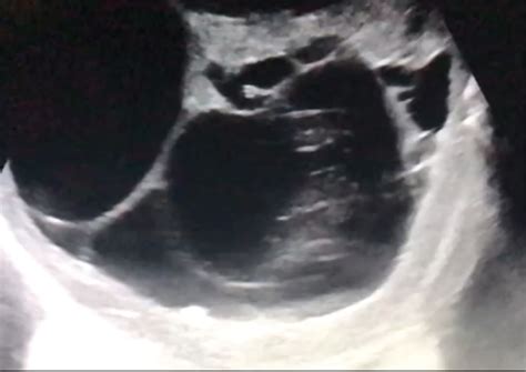 Intra Operative Ultrasound Assessment Of A Myometrial Cyst With