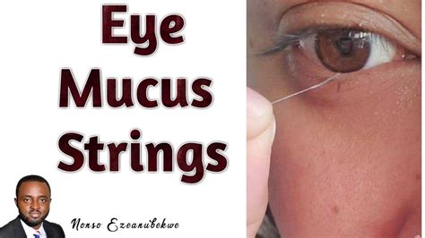 Eye Mucus Strings Mucus Fishing Syndrome Causes And Treatment