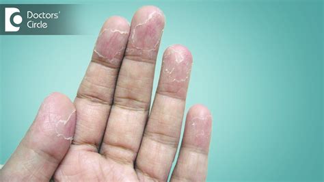 Finger Skin Peeling