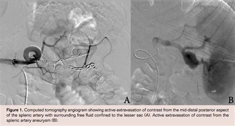 Postpartum Ruptured Splenic Artery Aneurysm Treated By Coil Embolization
