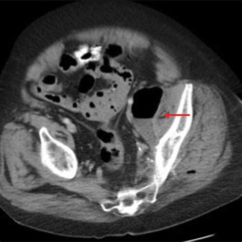 Initial Ct Scan Showing Abscess With Air Fluid Level Abutting Left
