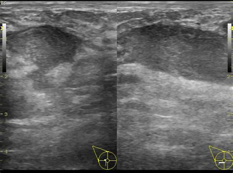Non Lactating Breast Abscess Image