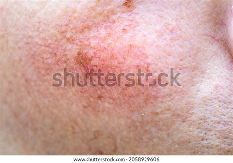 Broken Blood Vessels Over 416 Royalty Free Licensable Stock Photos