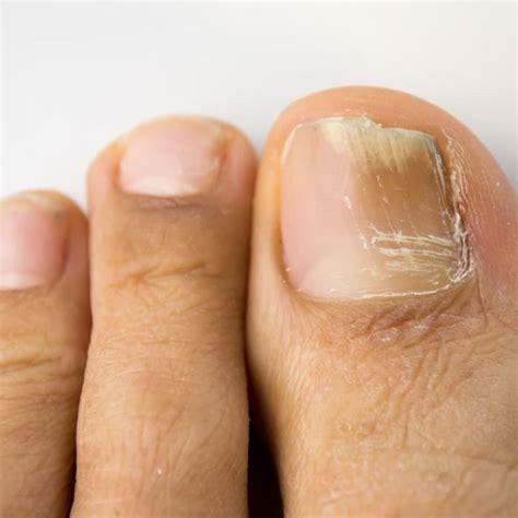 Fremont Ne Toenail Fungus Treatment Nail Disease And Abnormalities