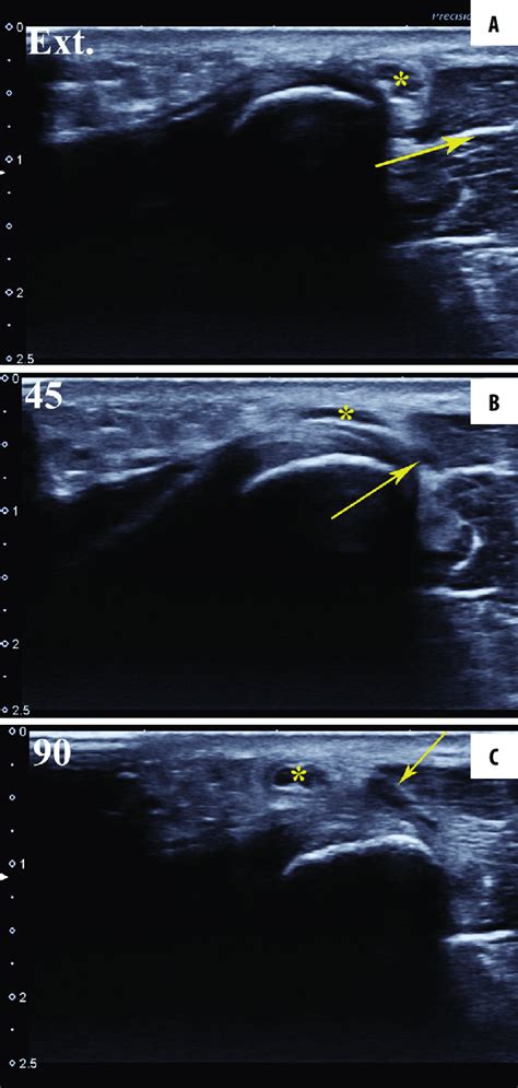 Dislocation Of The Ulnar Nerve And An Additional Muscle Band