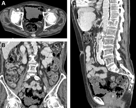 Emphysematous Cystitis Radiological Diagnosis Of Complicated Urinary