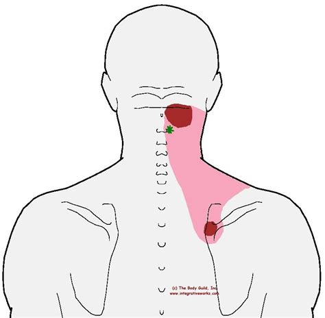 Understanding Trigger Points Neck Pain With Sore Shoulder