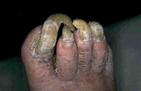 26 Of The Ugliest Feet In The World Page 23 Of 27 Poplyft