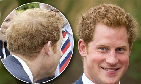 Últimas noticias de príncipe harry. El problema estético que afecta al Príncipe Harry — FMDOS