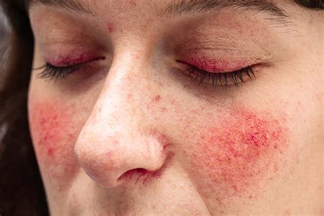 Persistent Red Rash On Cheeks Doctor Explains Scary Symptoms
