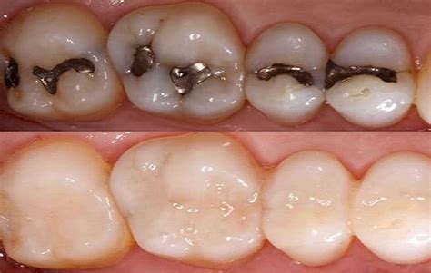 Tooth Colored Composite Fillings To Replace Silver